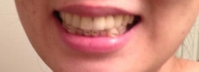 大人になって歯科矯正した方、しようと考えている方☆