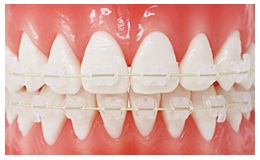 大人になって歯科矯正した方、しようと考えている方☆