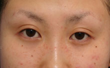 二重の整形した方!