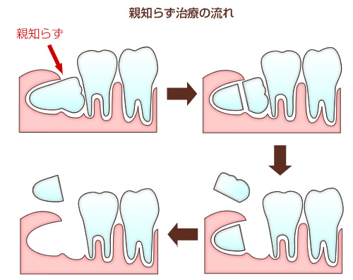 人体の役に立たない部位ベスト5