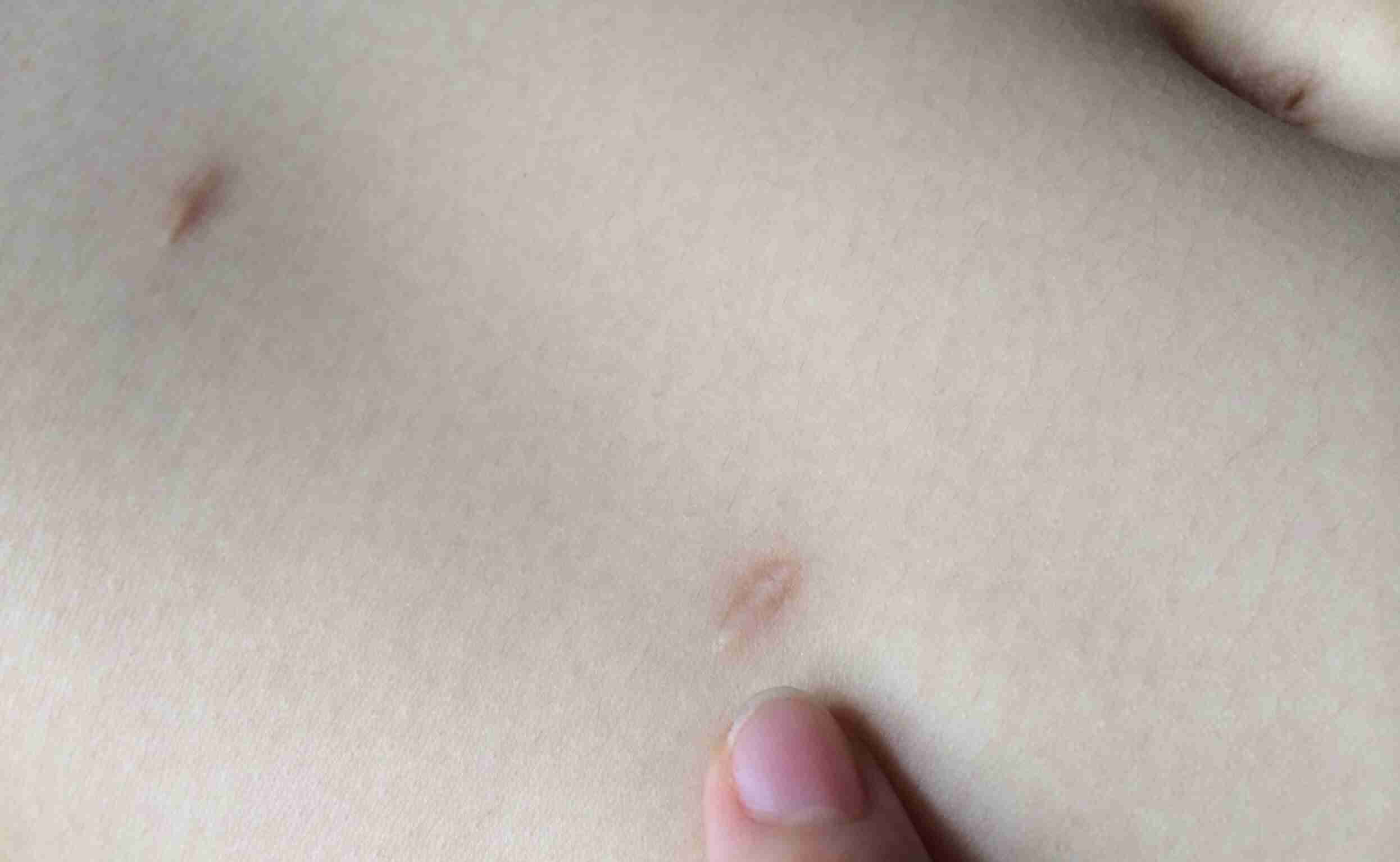 卵巣嚢腫、腫瘍と言われた方