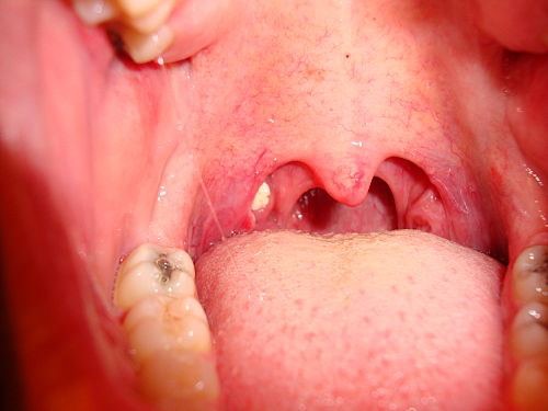 膿栓に悩まされてる方いませんか〜