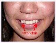 口元をいじったせいで残念になった芸能人は？