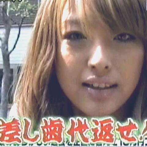 口元をいじったせいで残念になった芸能人は？