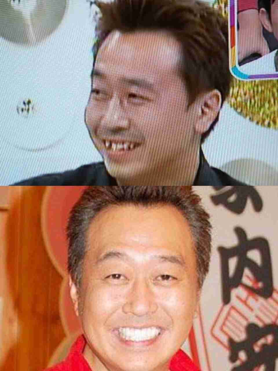 口元をいじったせいで残念になった芸能人は？