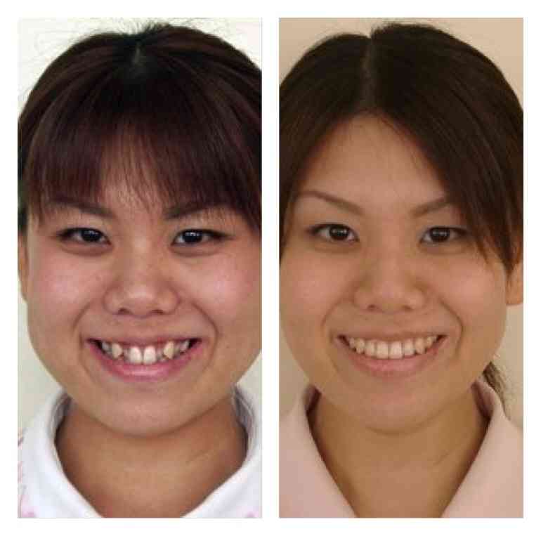 口元をいじったせいで残念になった芸能人は？
