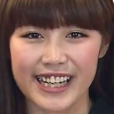 口元をいじったせいで残念になった芸能人は？