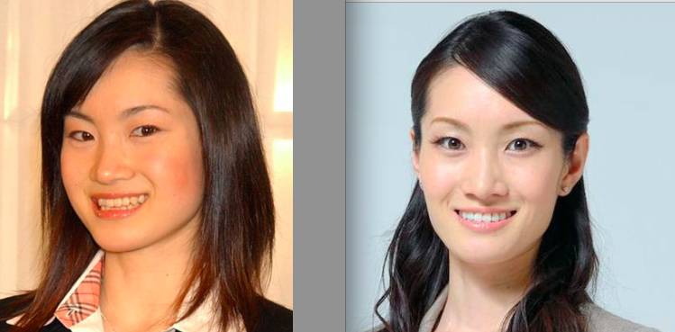 口元をいじったせいで残念になった芸能人は？