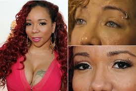 レーザーによりブルーの瞳を手に入れる!?米国でもすでに実験段階。