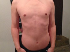 全身脱毛について