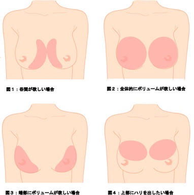 豊胸したことある人・したい人