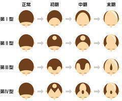 あなたはハゲを愛せますか？