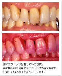 子供の仕上げ歯磨き いつまでしますか？