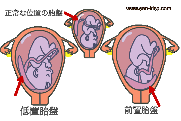 低置胎盤（前置胎盤）で出産された方