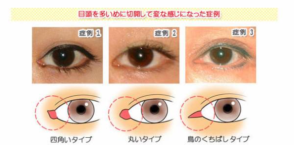 目頭切開していると思う芸能人