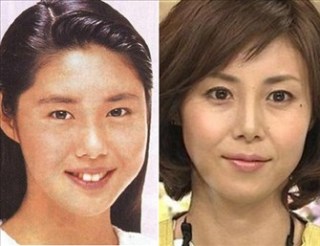 二重以外を整形している芸能人