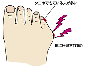 外反母趾の人！