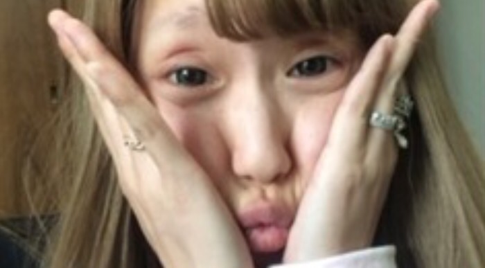 ややグロ整形手術動画もUP、ちいめろの理想は「自然界にあり得ない顔」