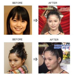 AKB48島崎遥香の鼻が以前と違うと話題に