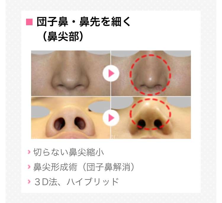 AKB48島崎遥香の鼻が以前と違うと話題に