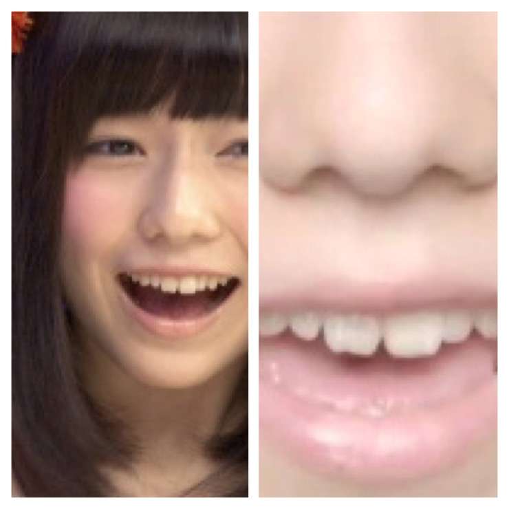 AKB48島崎遥香の鼻が以前と違うと話題に