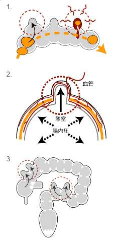 X JAPAN活動休止　PATAが大腸憩室炎と門脈血栓症で緊急入院