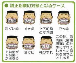 子供の歯列矯正