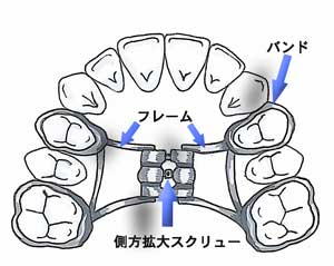 歯列矯正体験談