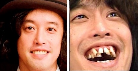 歯列矯正体験談