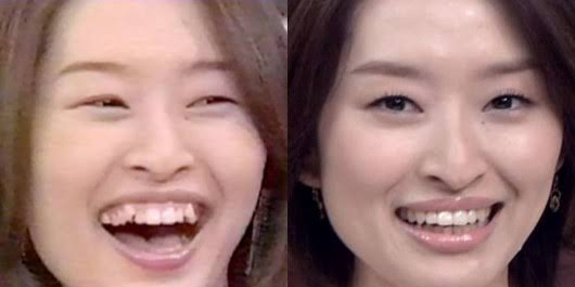 八重歯の女性について ガールズちゃんねる Girls Channel