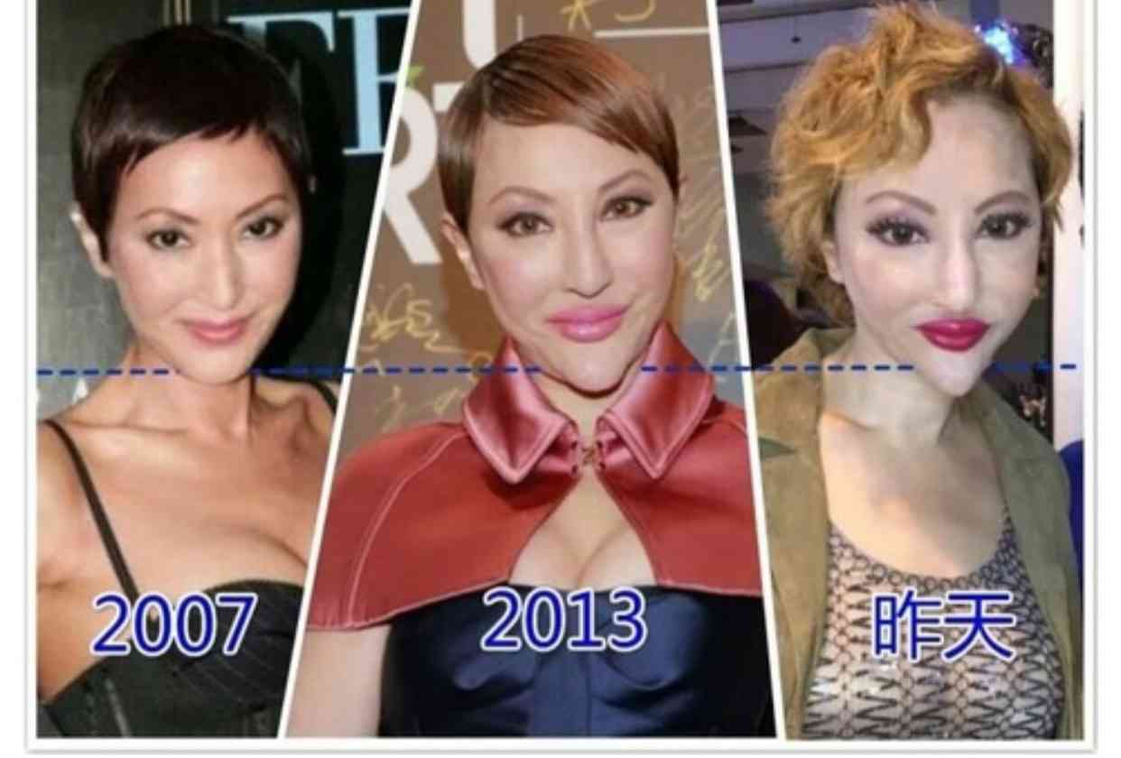 【閲覧注意】整形サイボーグ・ヴァニラがアゴ削りすぎ…？肉体の限界を心配する声