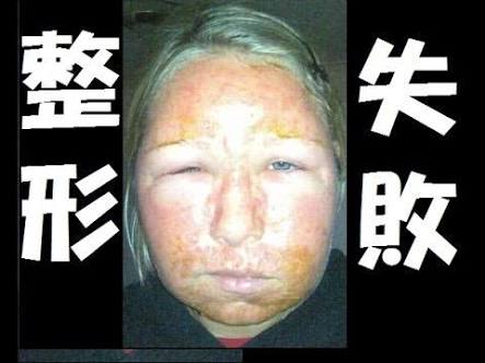 鼻の整形したことある人
