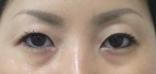 目の下のたるみ