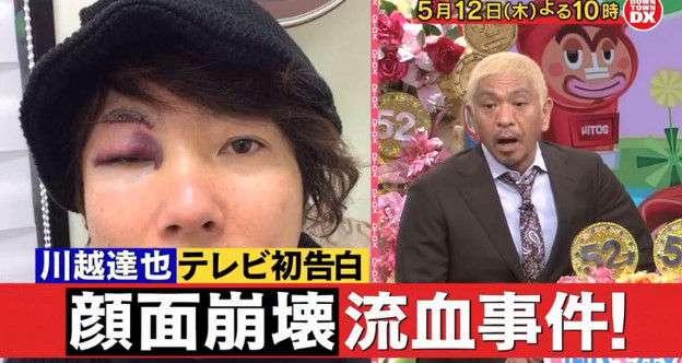 女児(９)が自動ドアぶつかり歯欠ける、スーパーに賠償命令