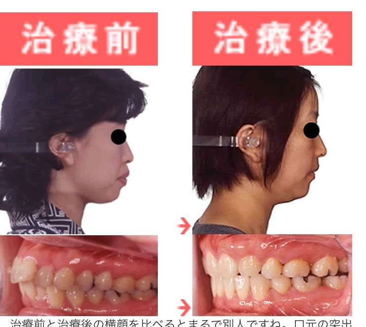 歯列矯正中辛かったことは？