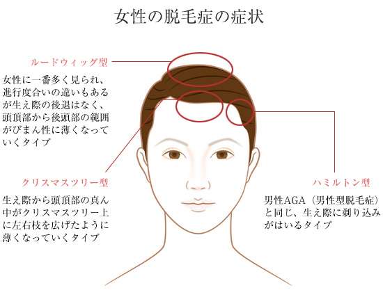 髪の悩みありますか？