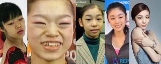 キム・ヨナが日本の芸能界デビューを狙って大整形手術