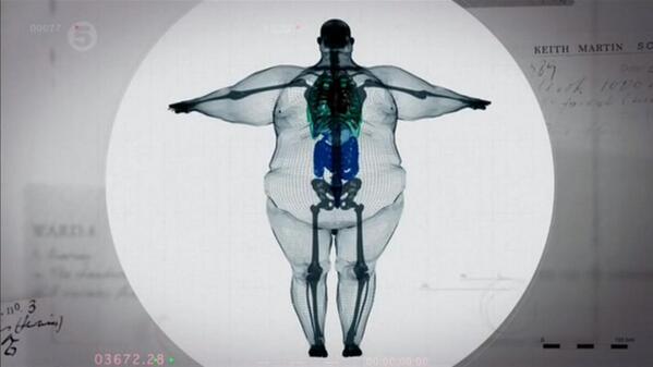 「体重500キロ」のエジプト女性、インドで手術へ