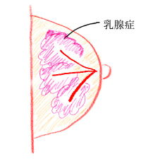 乳腺症の方語りましょう。
