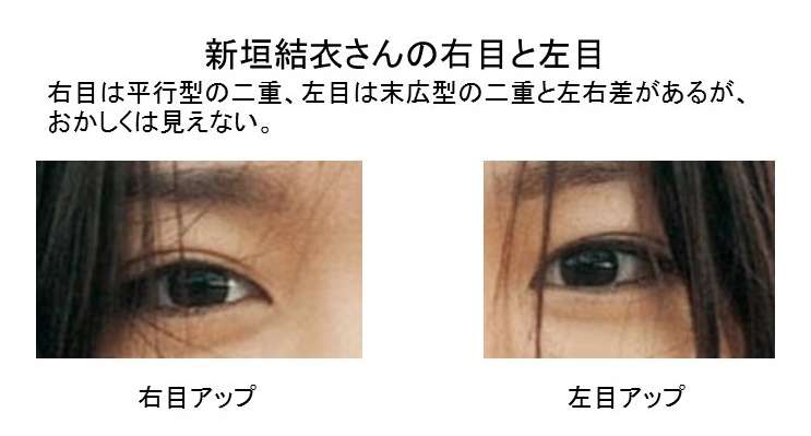 平行二重の目ってそんなにいいですか?
