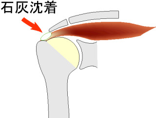 四十肩について真面目に語りたい