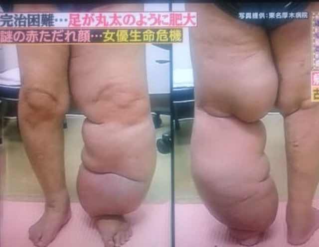 小林麻央が新治療！通い始めた「リンパ浮腫予防」クリニック