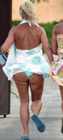 セルライトって何なの？