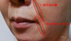 ほうれい線って消せる？