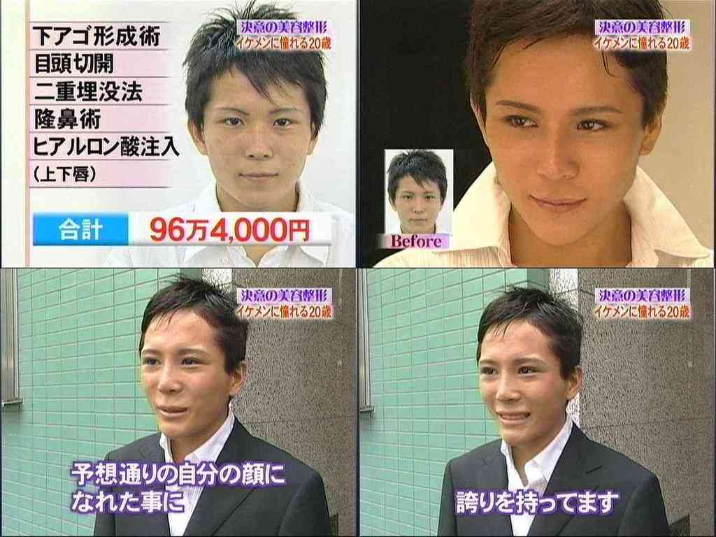 整形した人！  その後バレたりしましたか？