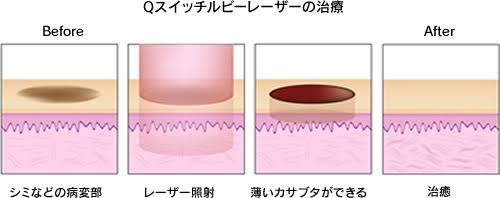 シミをレーザーでとった方