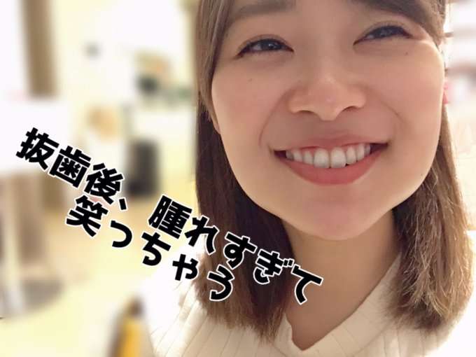 指原莉乃 体調不良で握手会中止 前日に親知らず4本抜歯