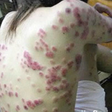 風俗嬢のソープで性病感染、尖圭 ...