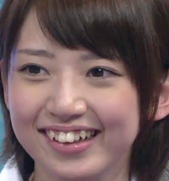 歯並びが悪い（悪かった）芸能人を挙げていくトピ