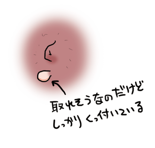 加齢による首イボ
